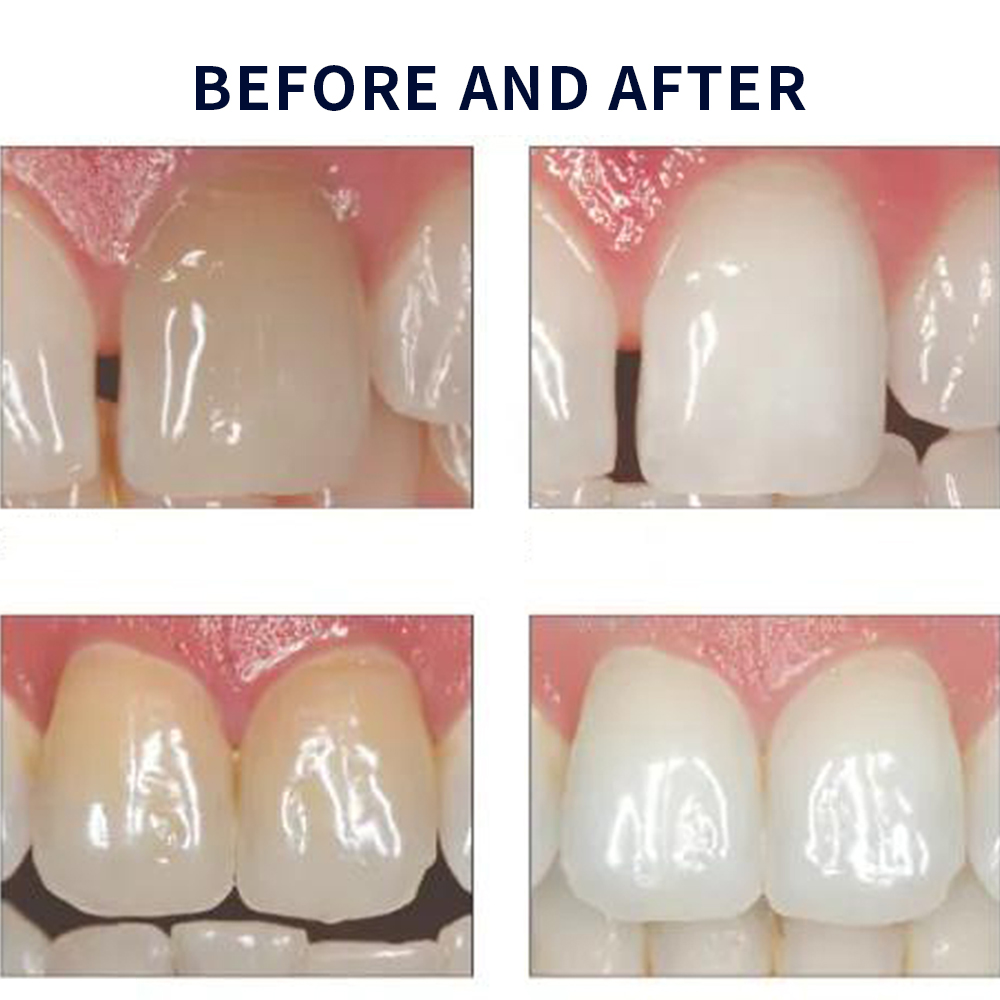 Opalescence Whitening 20% PF 2 - Teeth Whitening At Home recensione e prezzo