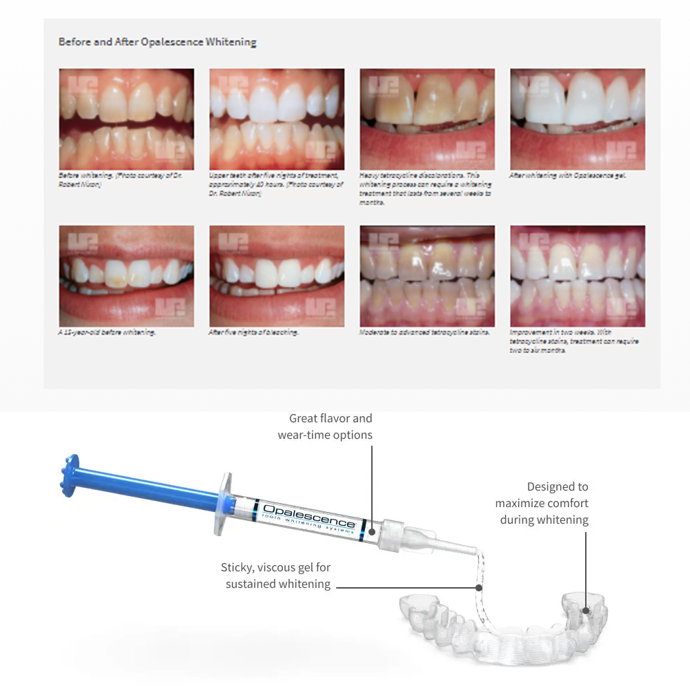 Opalescence Whitening 20% PF 2 - Teeth Whitening At Home recensione e prezzo