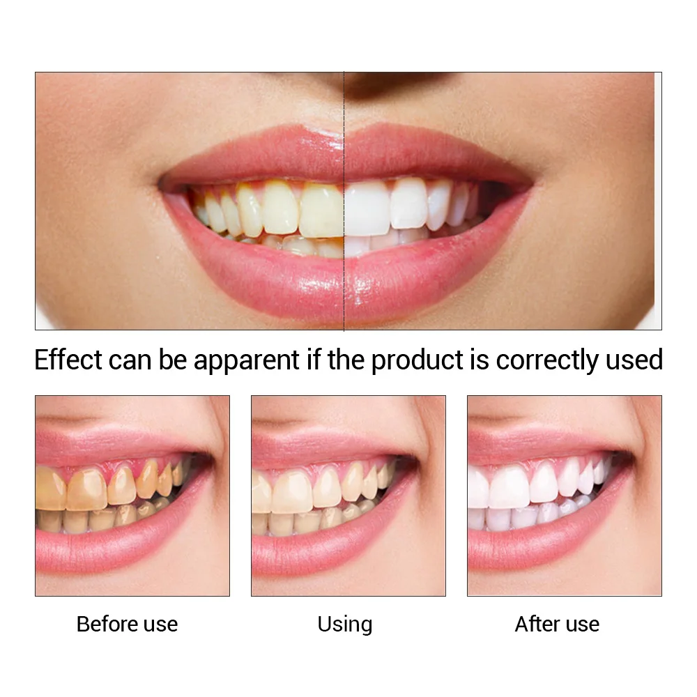 FTEENPLY Sbiancamento Dei Dent - Teeth Whitening At Home recensione e prezzo