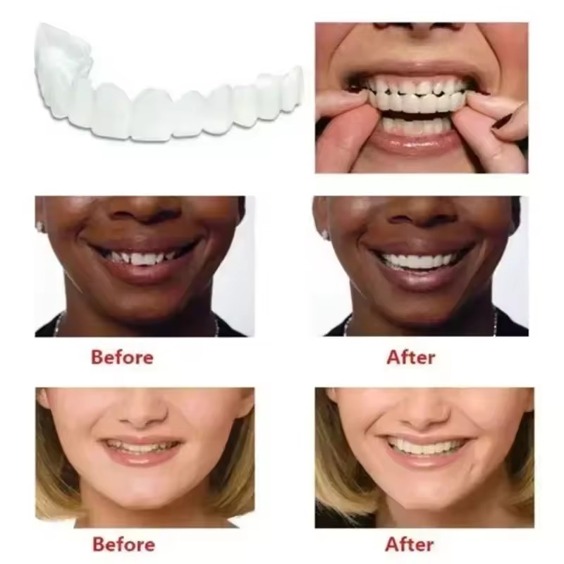 Faccette Dentali Sbiancanti, P - Teeth Whitening Kit recensione e prezzo