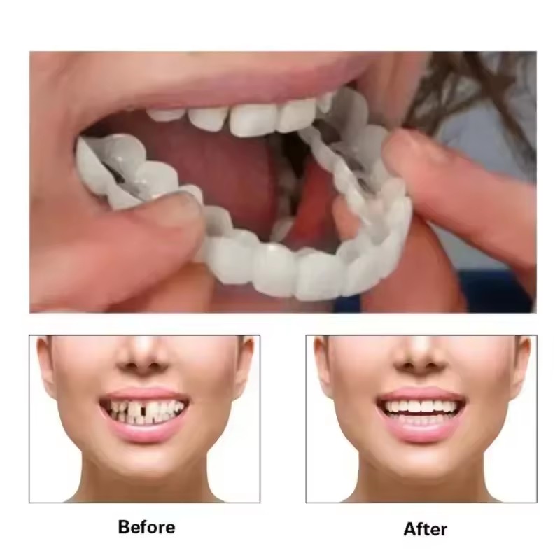 Faccette Dentali Sbiancanti, P - Teeth Whitening Kit recensione e prezzo