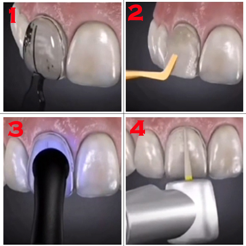 Stampo Dentale per Faccette in - Teeth Whitening Lab recensione e prezzo